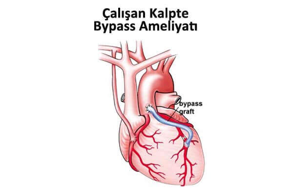 Çalışan Kalpte Bypass Ameliyatı Nedir?